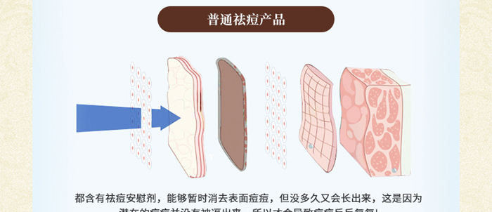 苗悦堂草本植萃祛痘组合