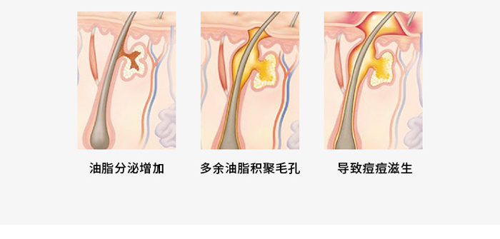 朵旎祛痘修护原液